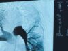 Realizan la primera trombectomía pulmonar en Iquique y la segunda en el norte de Chile