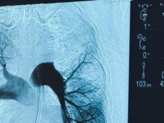 Realizan la primera trombectomía pulmonar en Iquique y la segunda en el norte de Chile
