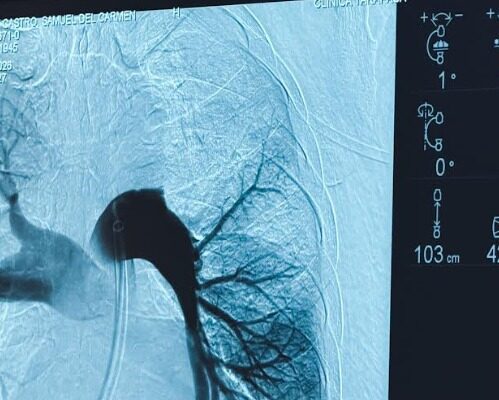 Realizan la primera trombectomía pulmonar en Iquique y la segunda en el norte de Chile